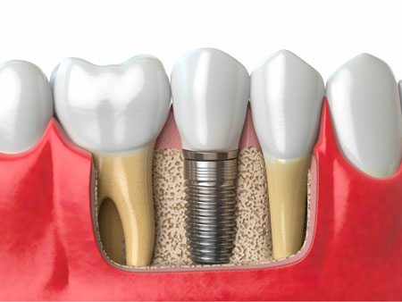 Implantes dentales: ¿duele mucho la cirugía?